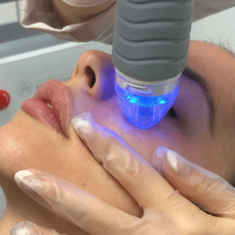 Birthday Sale - Virtue RF Microneedling