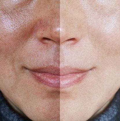 Birthday Sale - IPL Sun Spot Removal