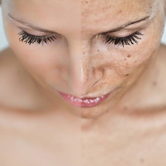 The Next Chapter Event -  IPL Photofacial