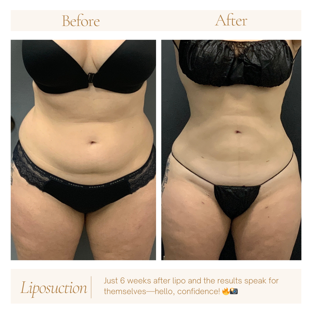 Birthday Sale - $250 Off 2 Areas of Liposuction Plus 1 Month Supply of GLP-1 FREE!