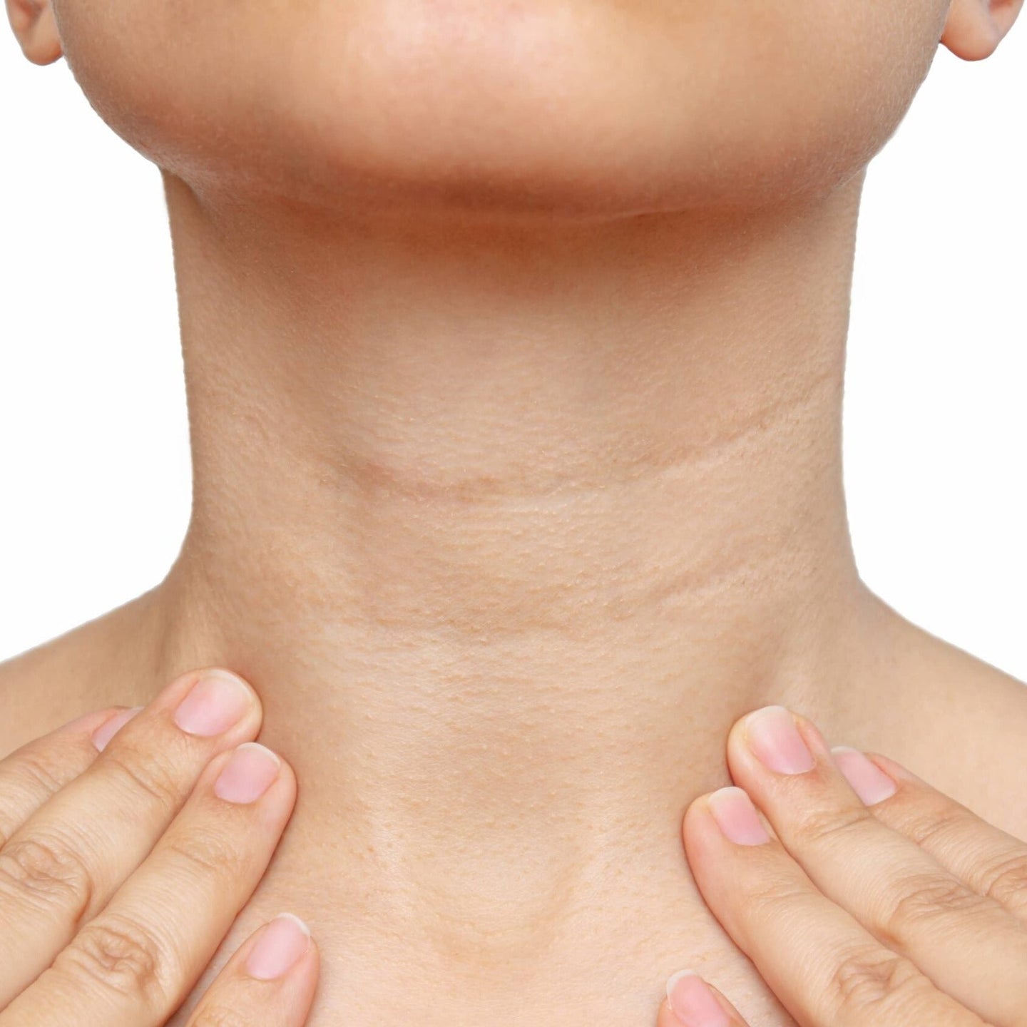 25% Off Ultherapy Full Neck